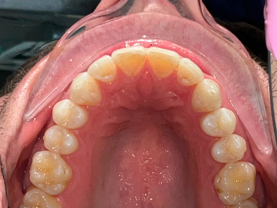 24780351_Parker_Ramsdell_4_Upper_Jaw 2