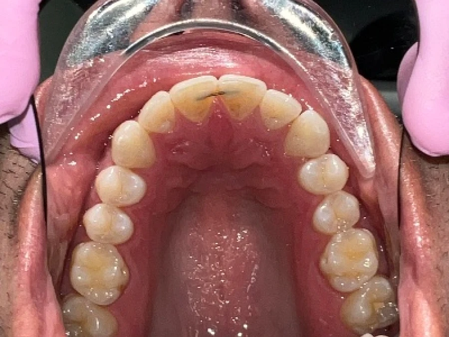 [TN640x400]-VOI58499961_i_occlusal_maxillary 1