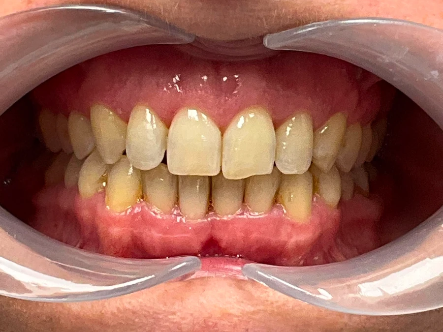 labial_anterior-FINAL-stage29-Jun 19 2026 1